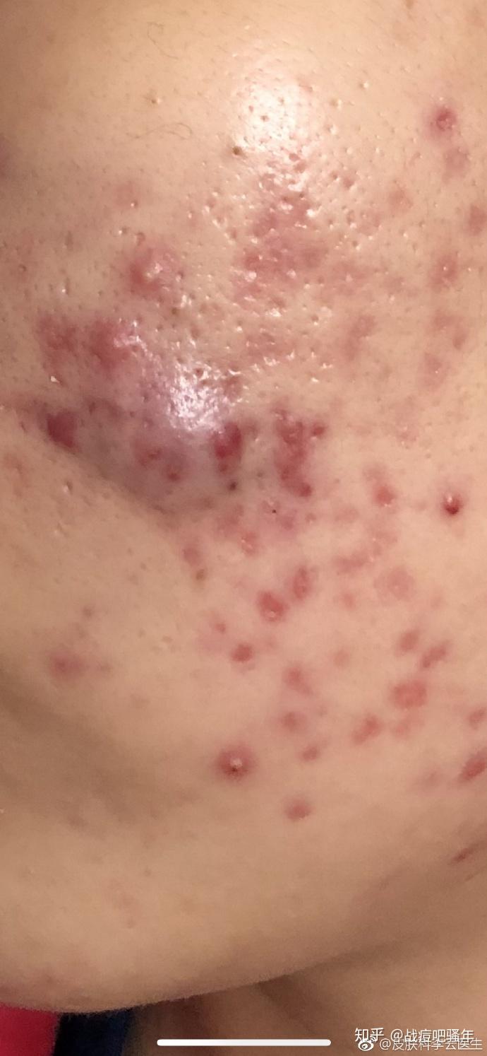囊肿型痘痘怎么消下去? - 知乎