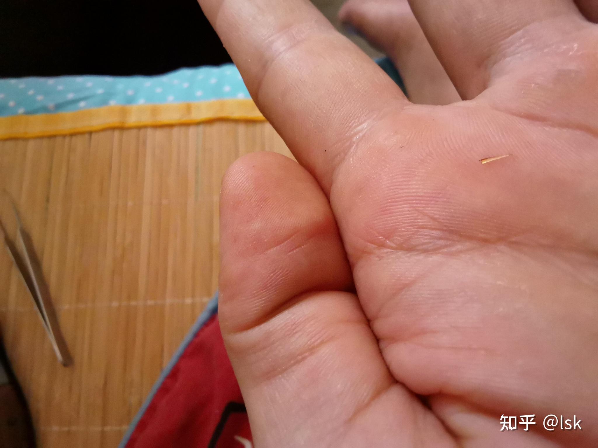 不小心玻璃扎进手里,我把外面可以看见的夹了出来,但是感觉里面还有