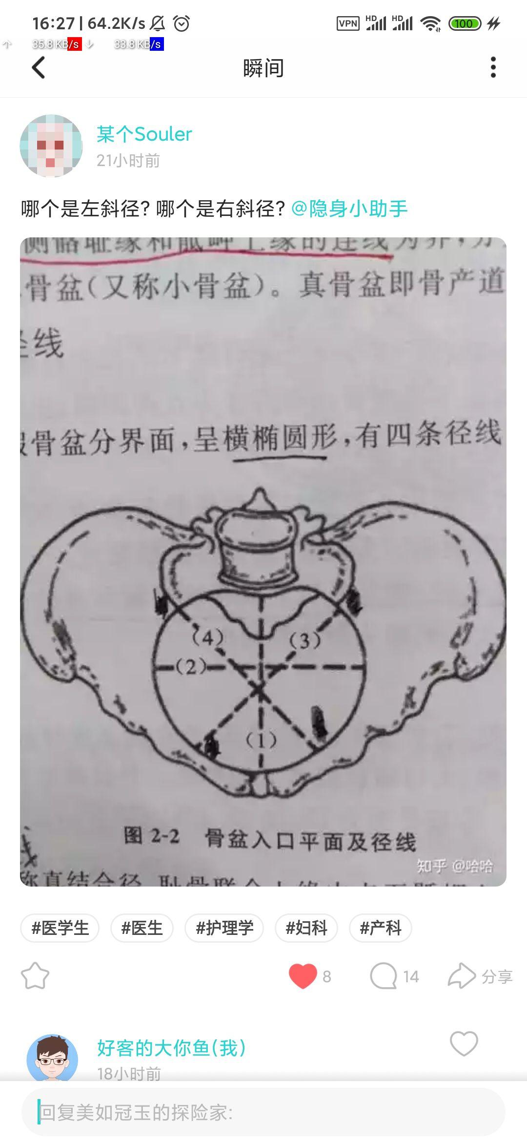 骨盆入口斜径,怎么区分左右斜径,哪条线是左斜径,哪条线是右斜径?