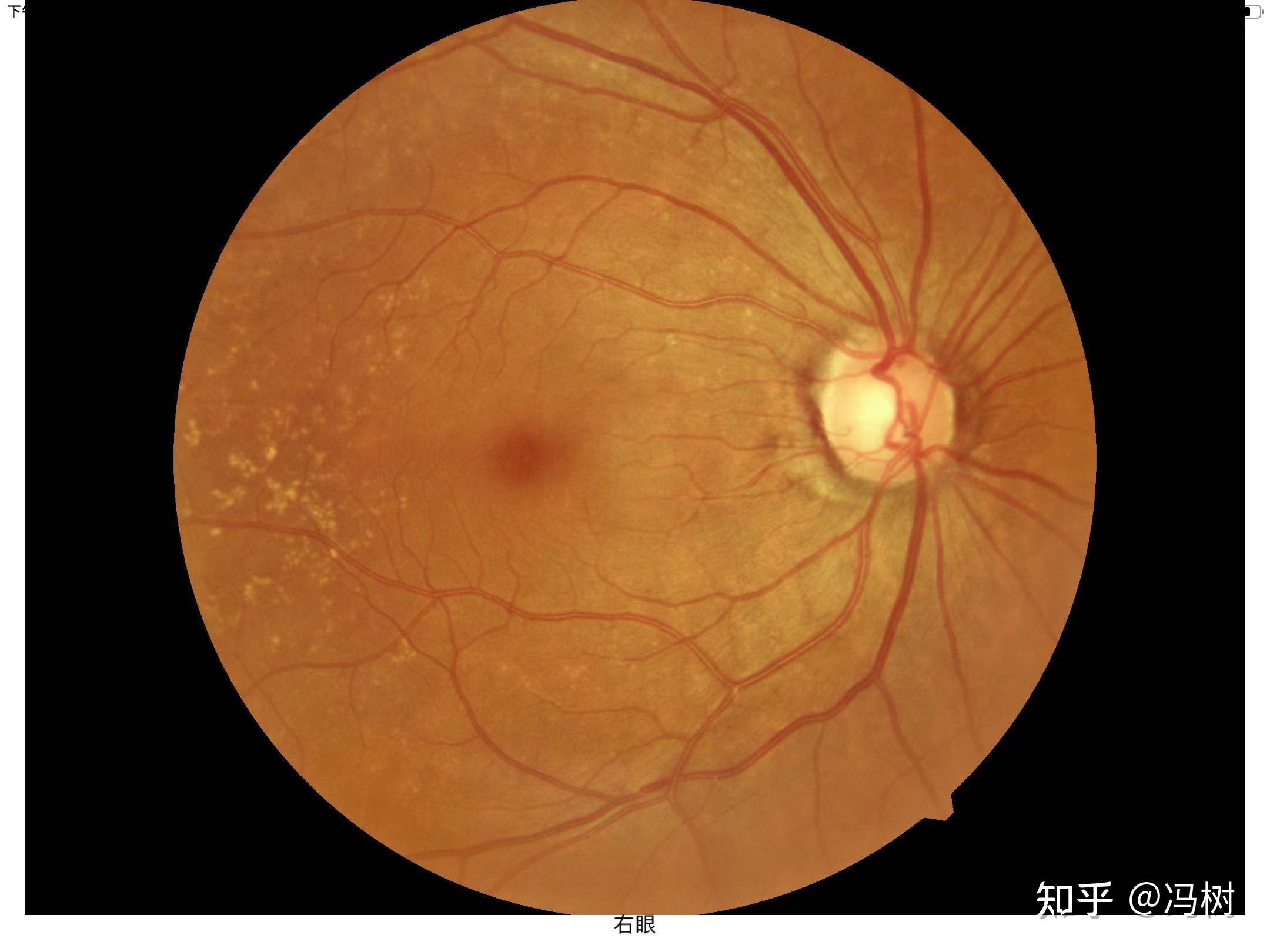 病患者发现眼睛有问题,到眼科检查才知道是糖尿病引起的视网膜病变