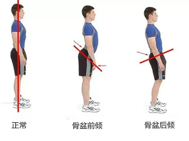 【增高长高方法】骨盆前倾是什么？有什么危害？怎么矫正？ - 知乎