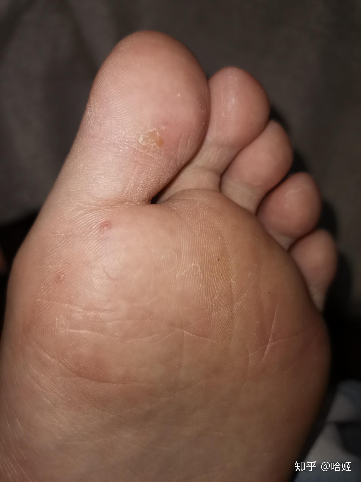 液氮冷冻治疗后手指上出了血泡而且越来越大该怎么办