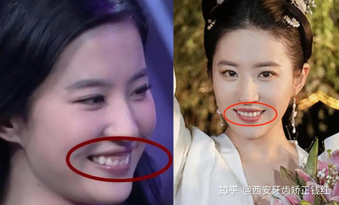 女朋友不肯去矫正地包天怎么办? - 知乎