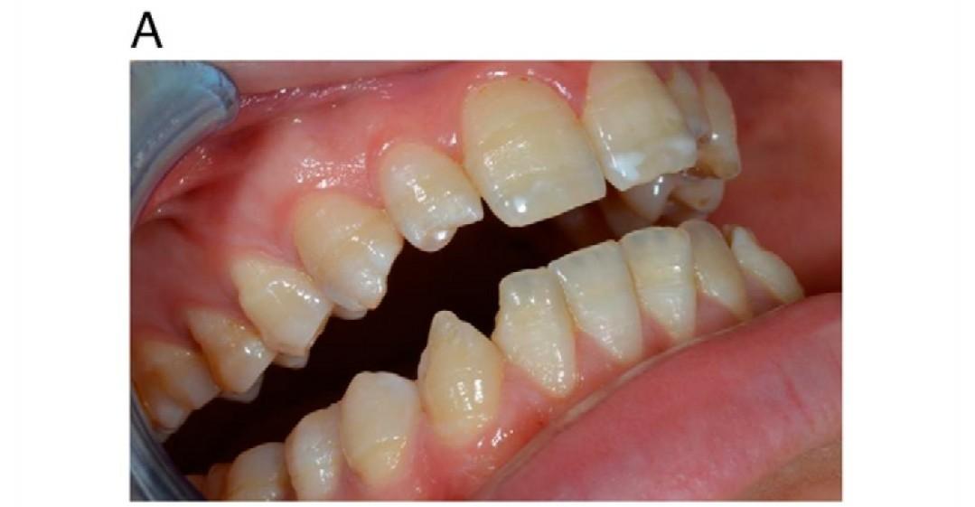 釉质钙化不全釉质发育不全与氟斑牙的区别是什么有图片吗