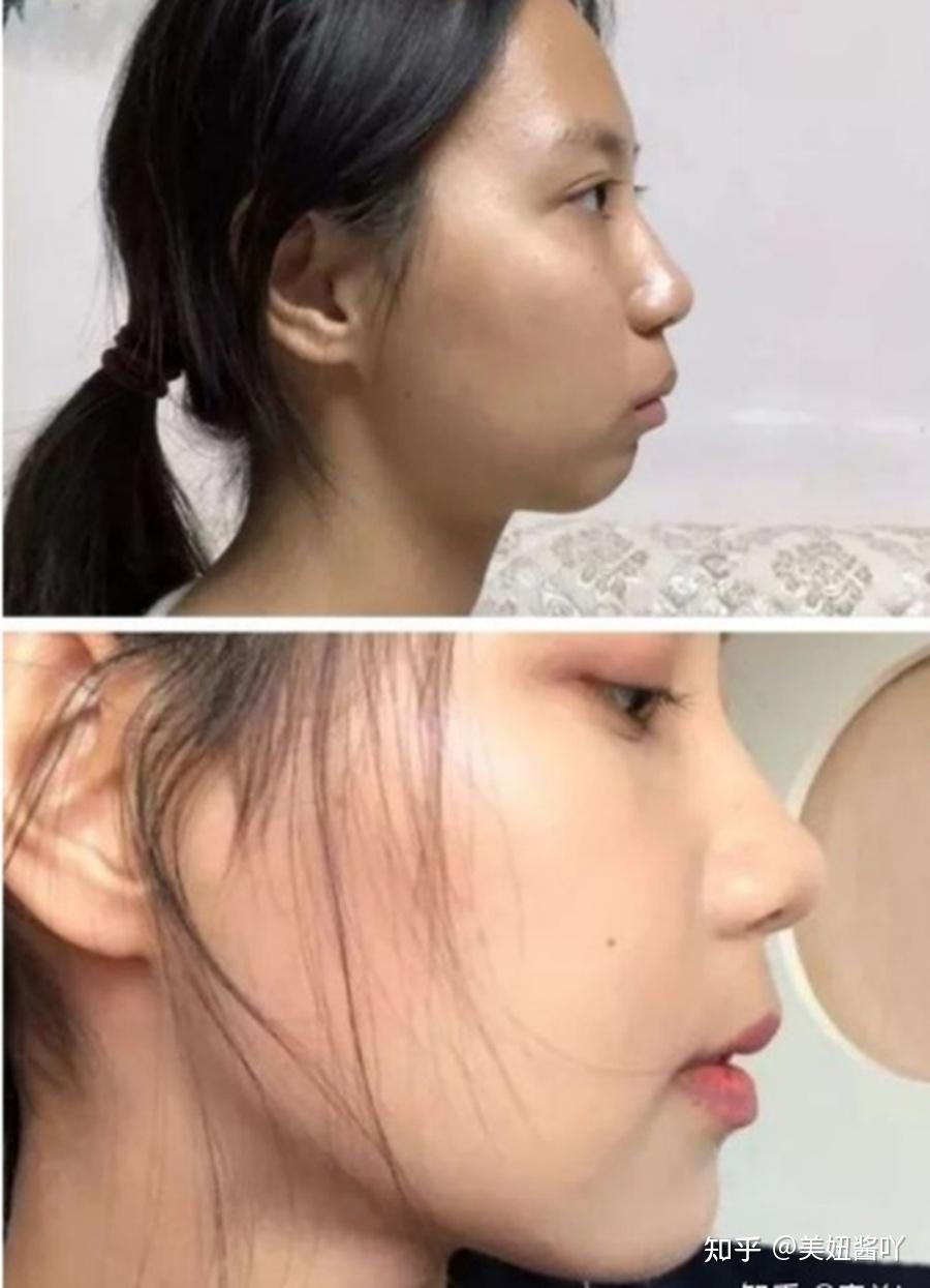 你们觉得凸嘴和地包天哪个更丑? - 知乎