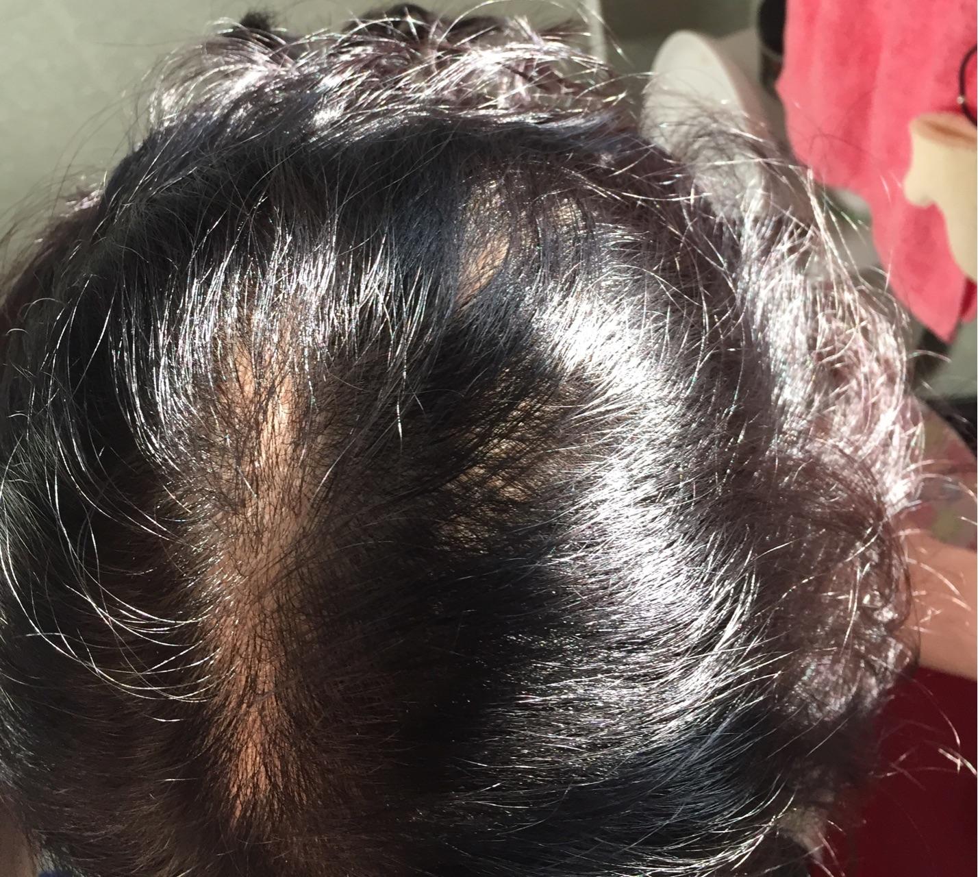 24岁女生,头顶非常稀疏,细软少? - 知乎