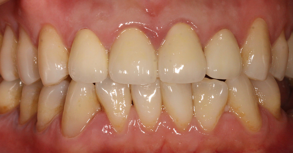 牙齿正畸需要拔掉4颗牙齿之后只剩下24颗牙齿这样正常吗