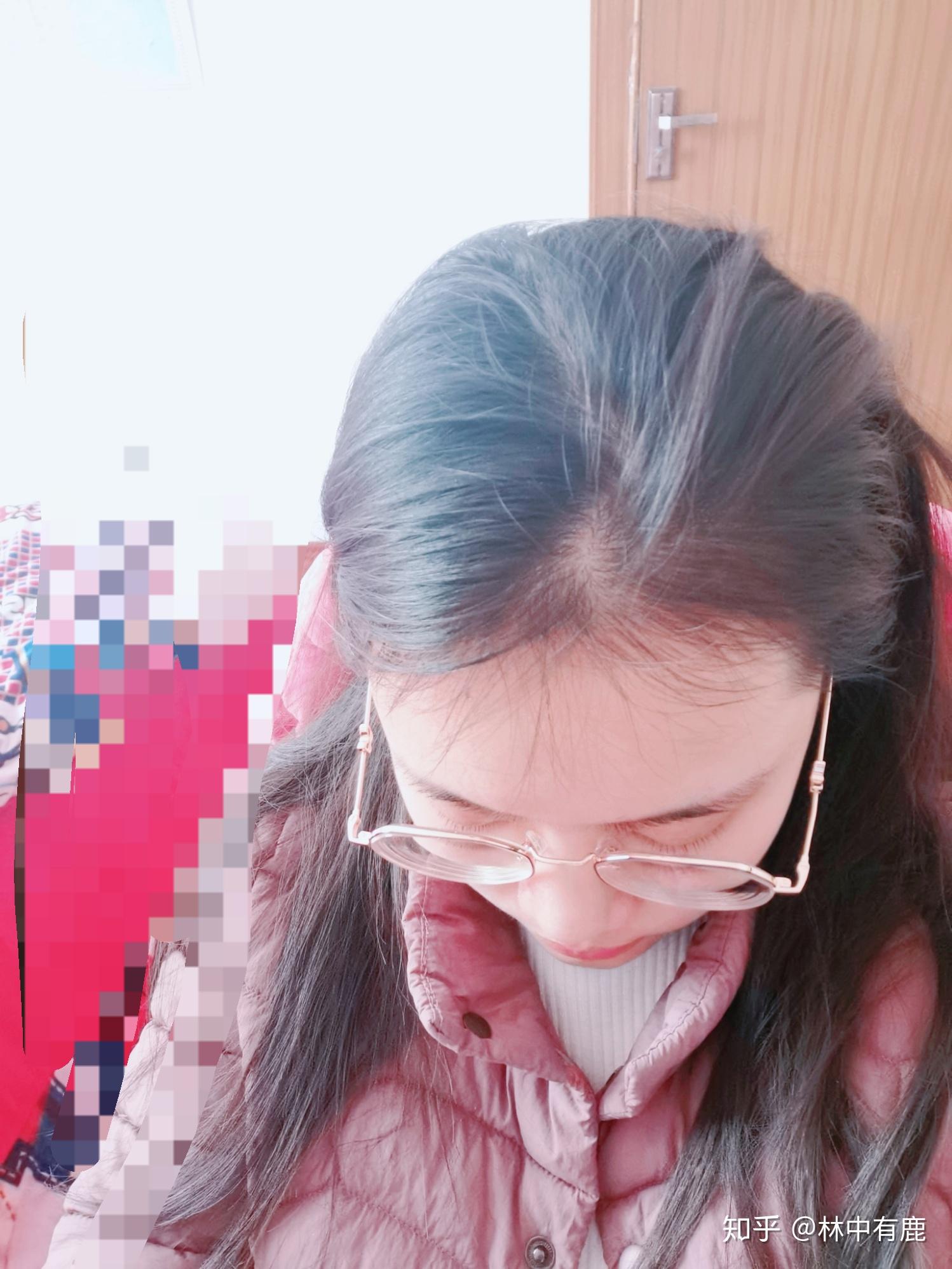 女生秃顶是怎样一种体验?