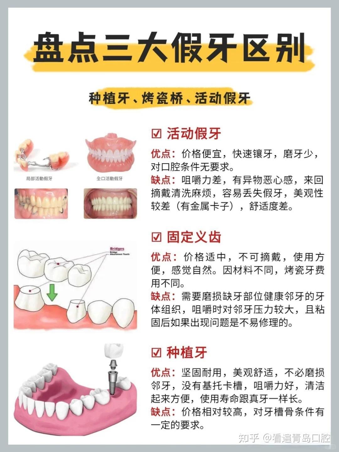 缺牙了不一定要种植!三种方式大盘点! - 知乎