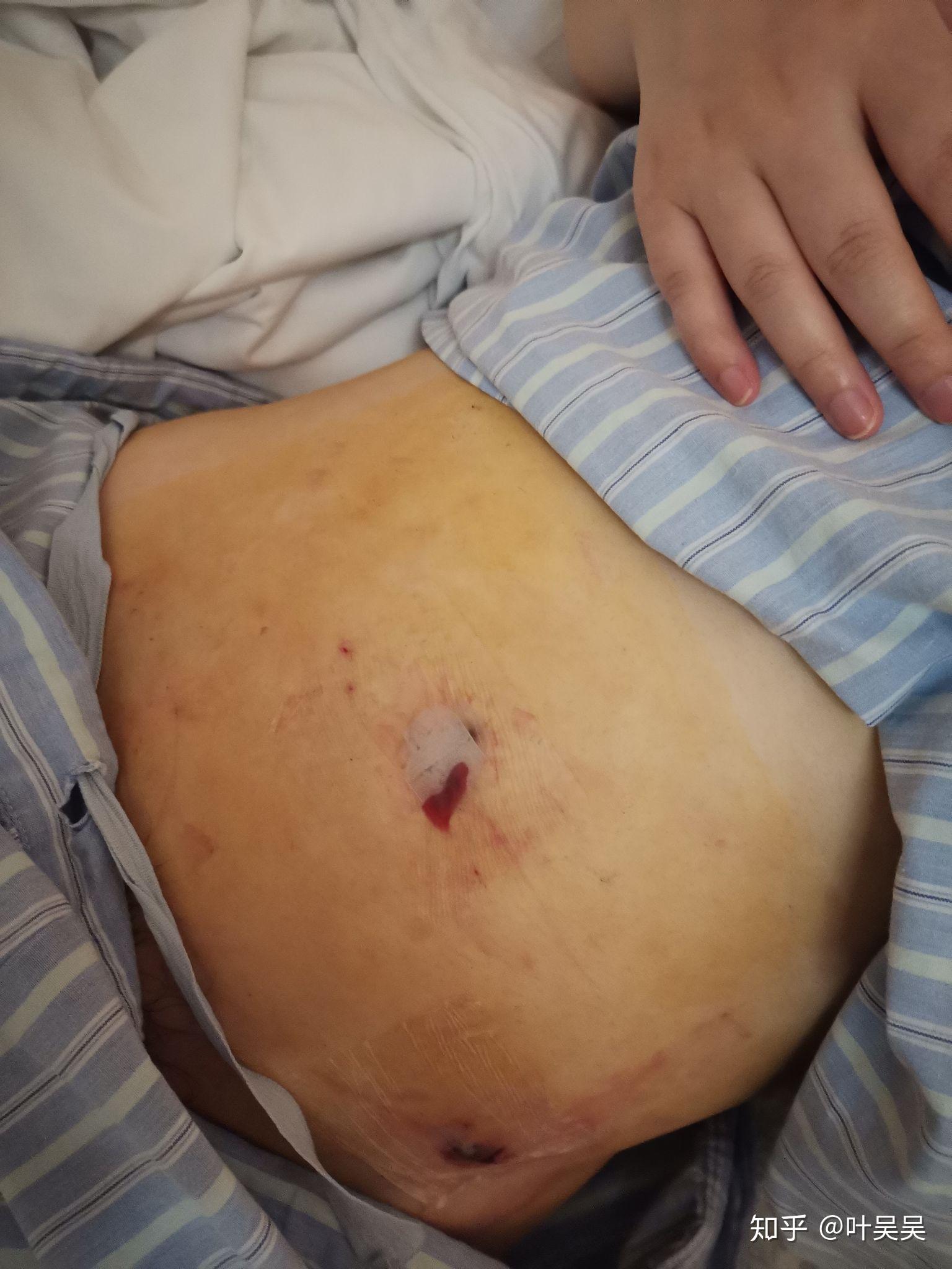 做微创阑尾炎手术是一种什么体验?