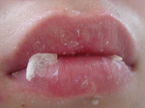 不愿意嘴唇被涂得油光满满但又严重干裂起皮怎么办?