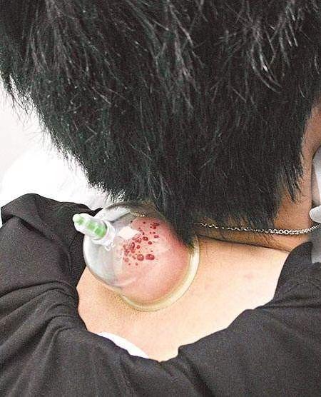 富贵包拔罐法是否有效?