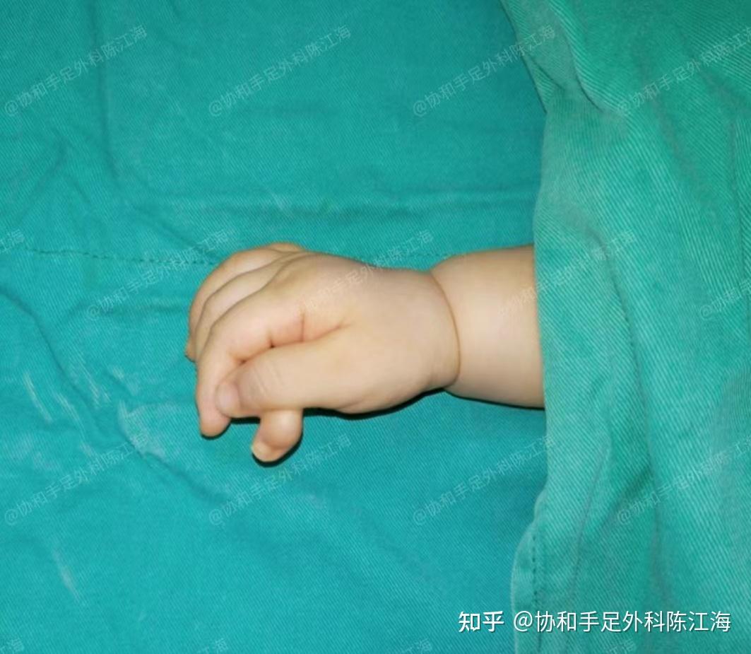 六指割掉后能入伍吗? - 知乎