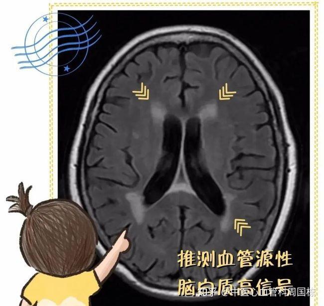 腔梗和脑梗是什么? - 知乎