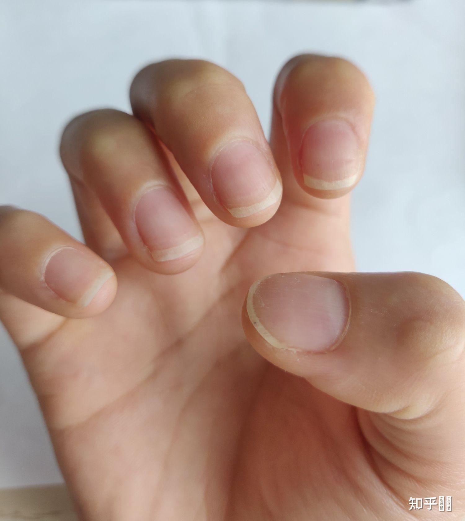 整块指甲抠得基本不剩了这样指甲能不能再长好呢