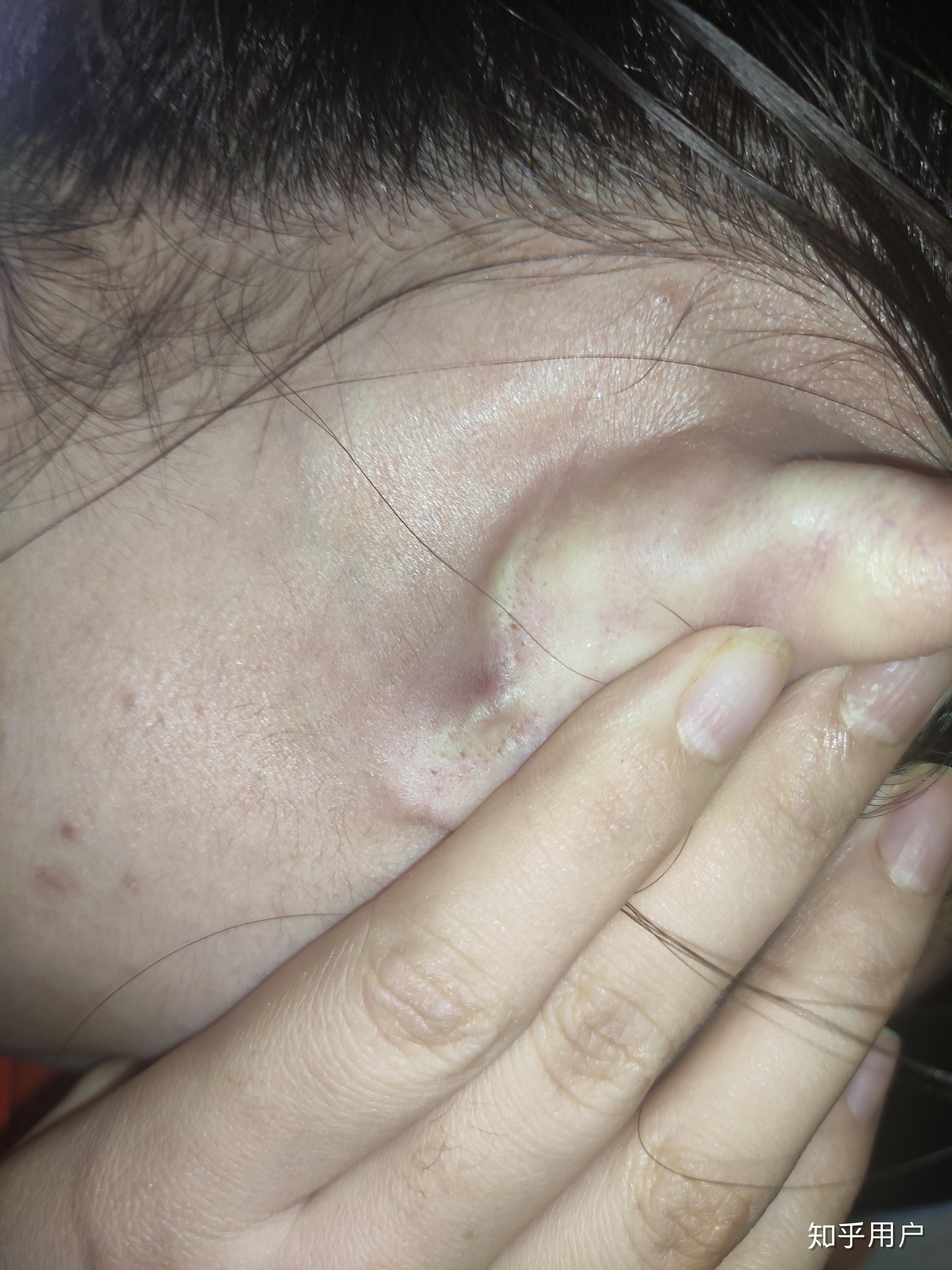 耳朵后面长了个包,是什么? - 知乎