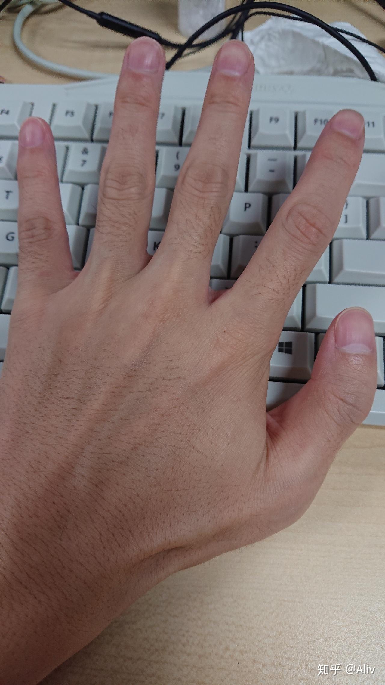 一只手有六个手指是种怎样的体验