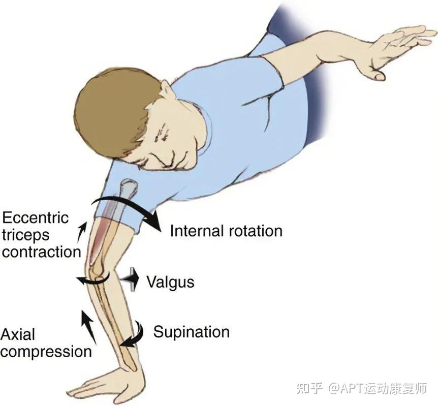 肘关节骨折,怎么康复训练?