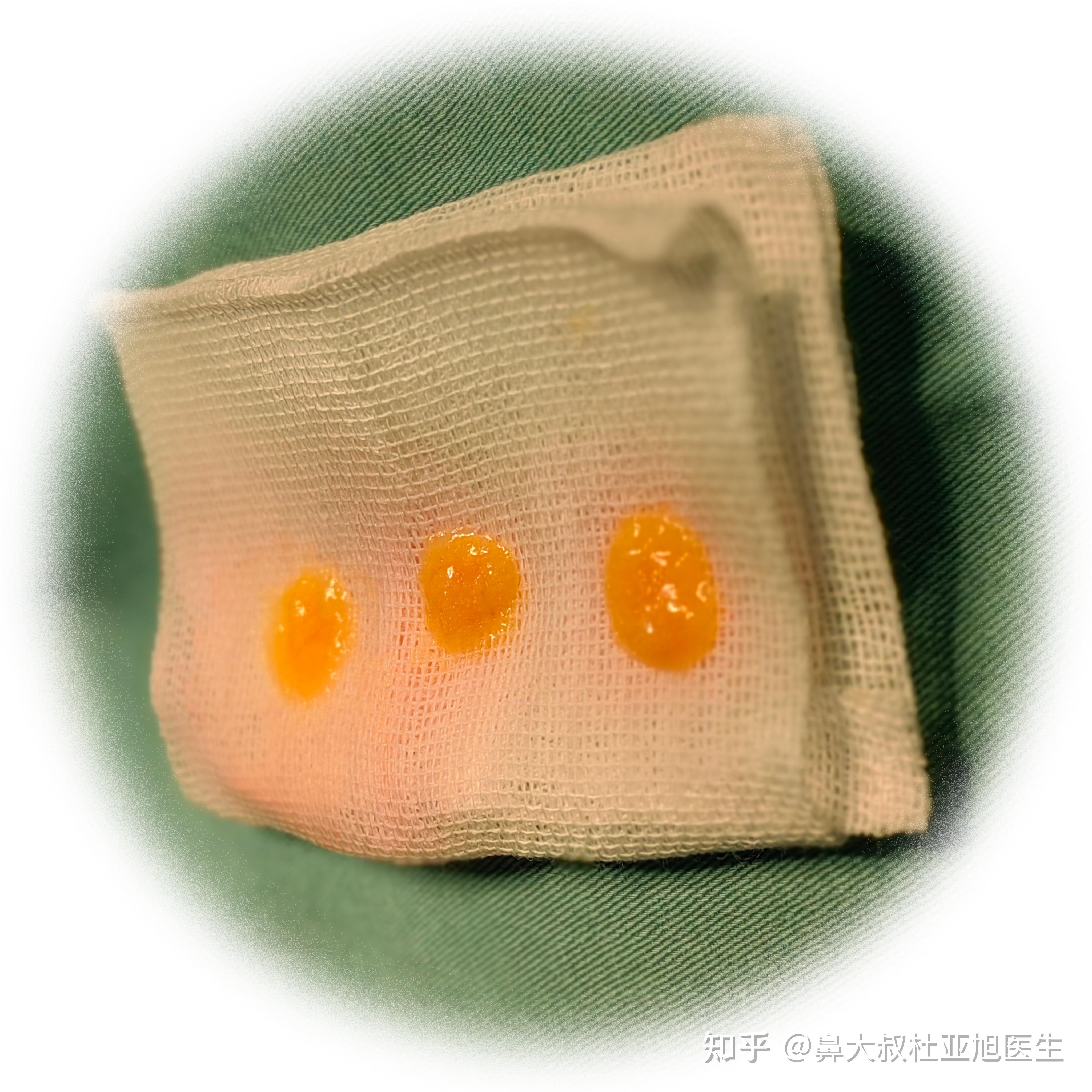 由于注射后可能发生部分脂肪颗粒的聚集,以及周围组织的创伤反应,可能
