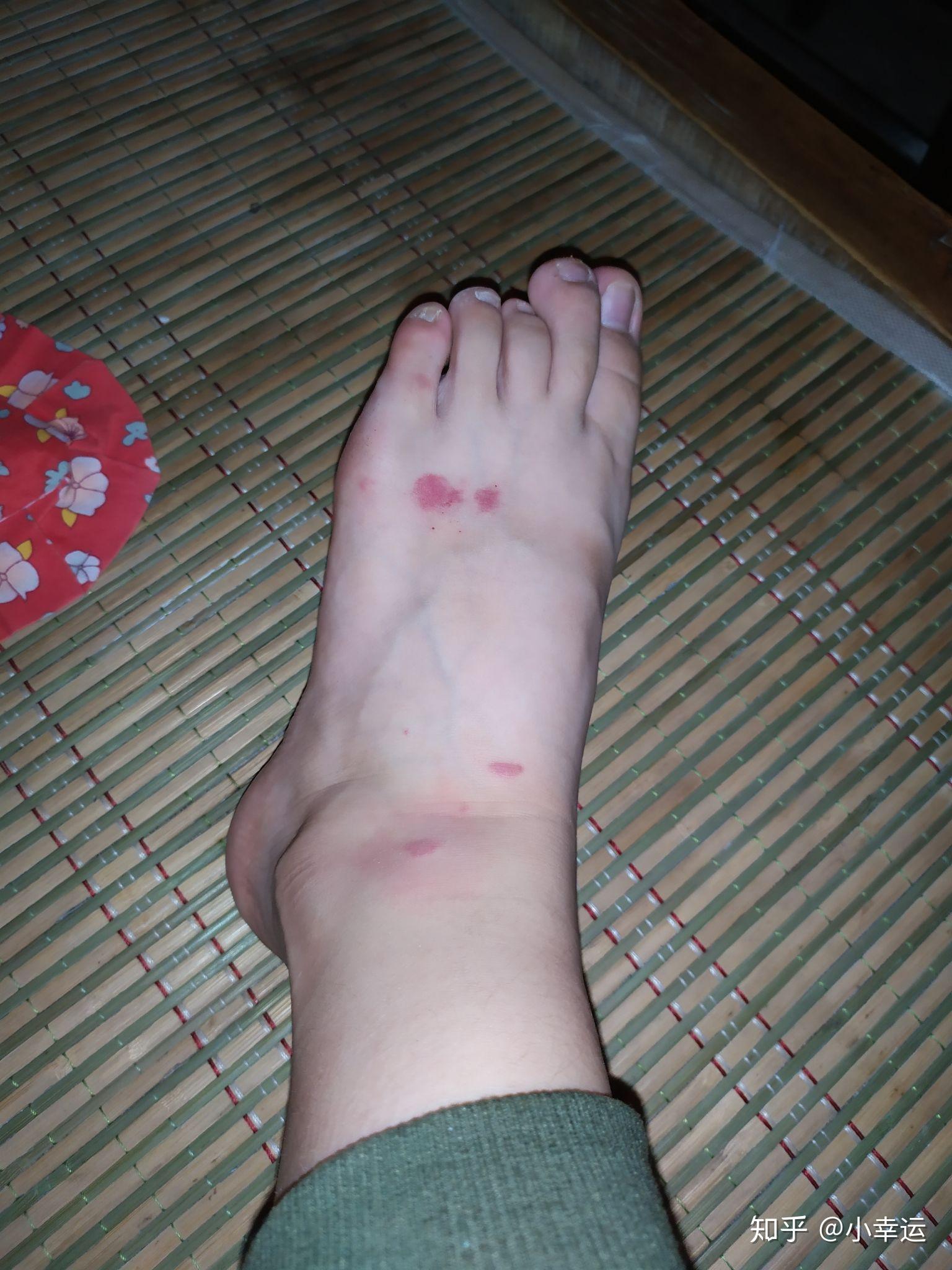 被跳蚤咬的全身都是包是什么样的感受