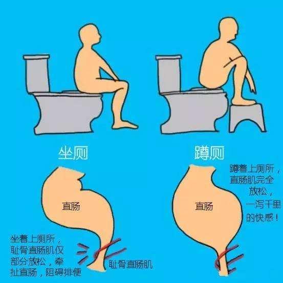 预防痔疮第一步大便时换个姿势