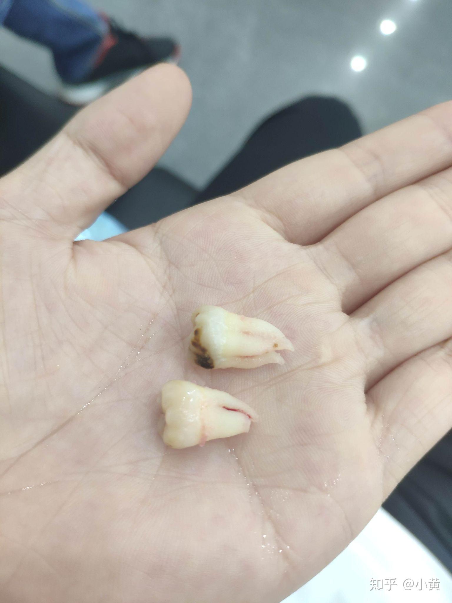 智齿长得很好(即正位不痛)是什么体验? - 知乎