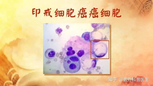 歌手吾恩确诊胃印戒细胞癌,印戒是最恶的吗?还有多长生存时间? - 知乎
