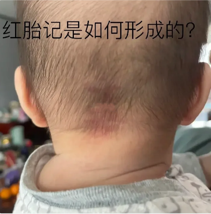 红胎记是如何形成的呢? - 知乎