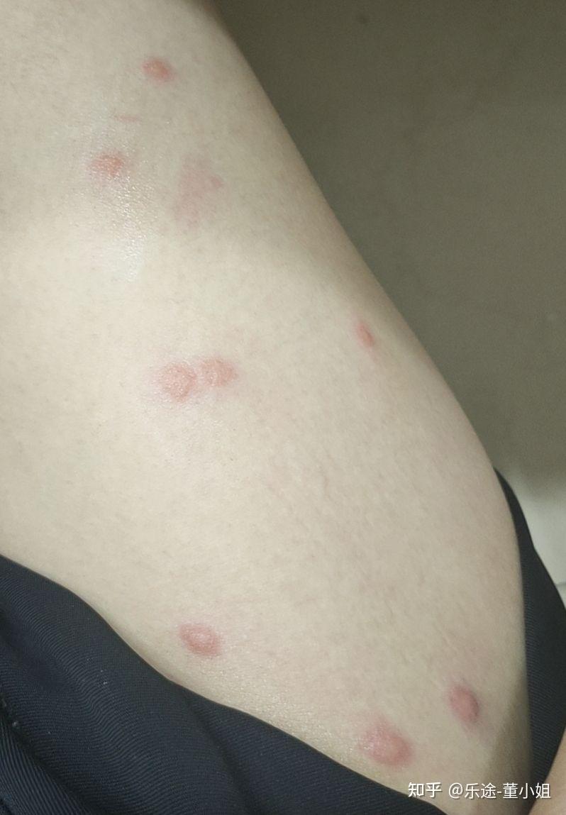 我腿上长了好多这种小包很痒硬硬的