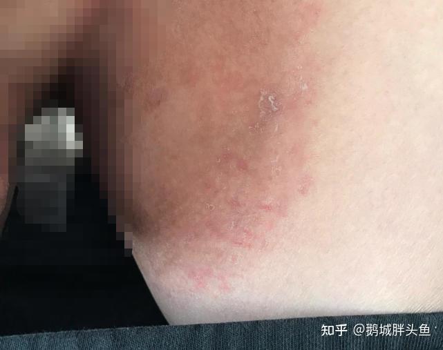 你们有过股藓的经历吗？ 知乎 
