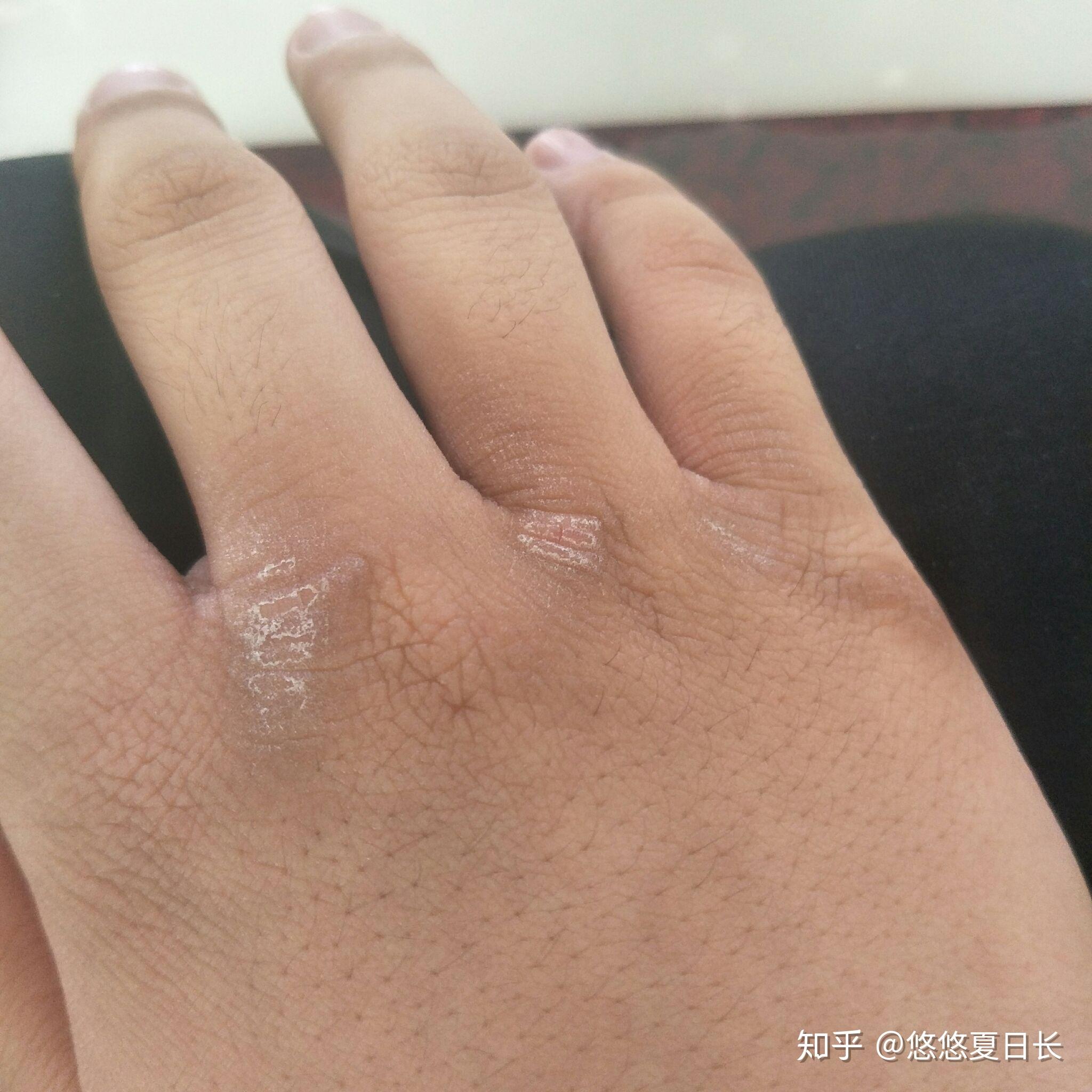 我的两个手指之间的皮肤变黑变硬怎么办? 