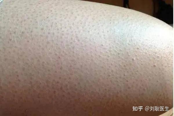 肩膀上的毛孔上都是小黑点怎么办? - 知乎