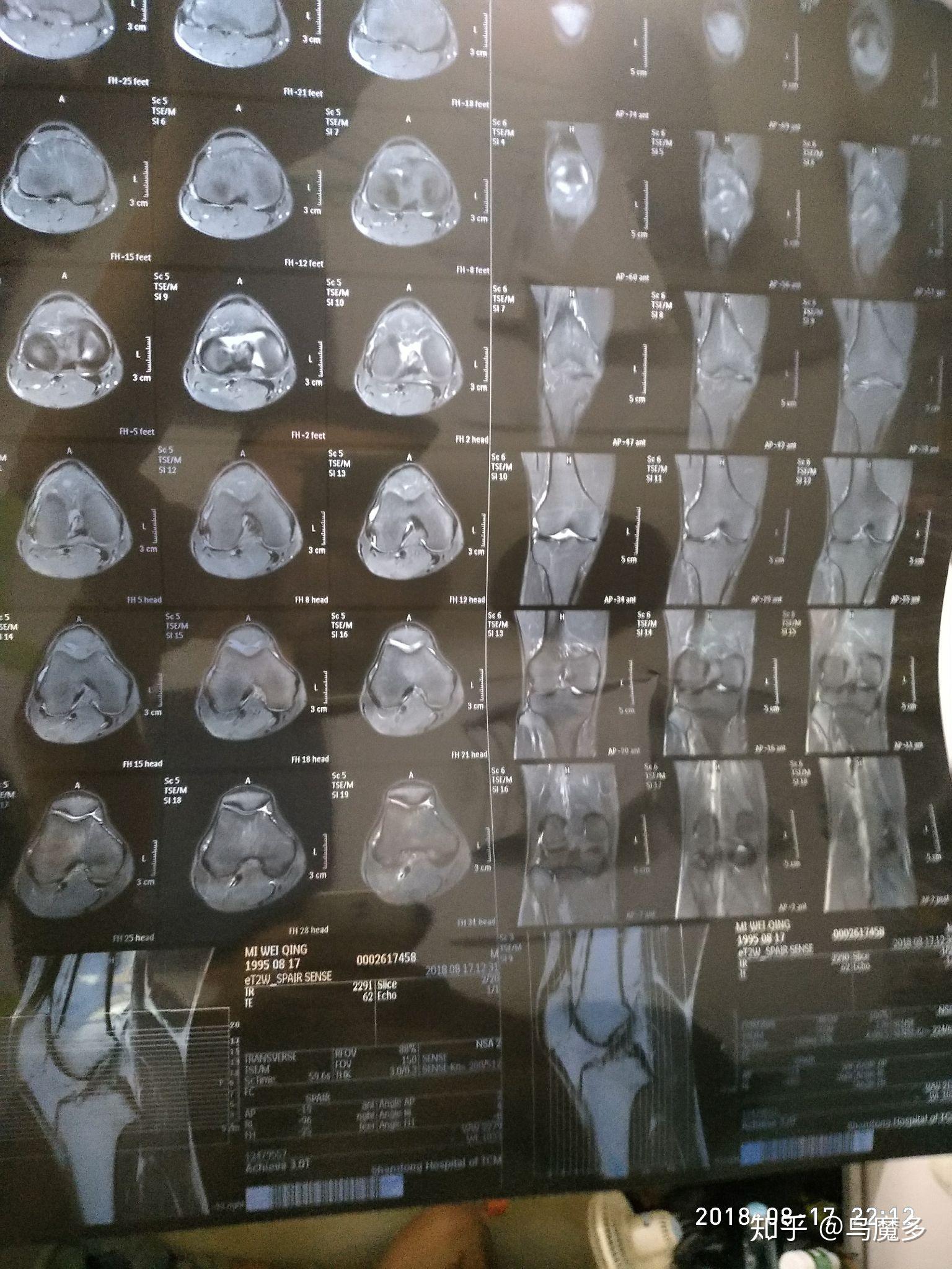 膝盖积液是一种怎样的体验