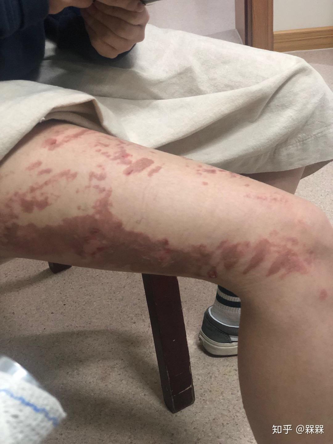 被开水烫伤大腿应该怎么办. - 知乎