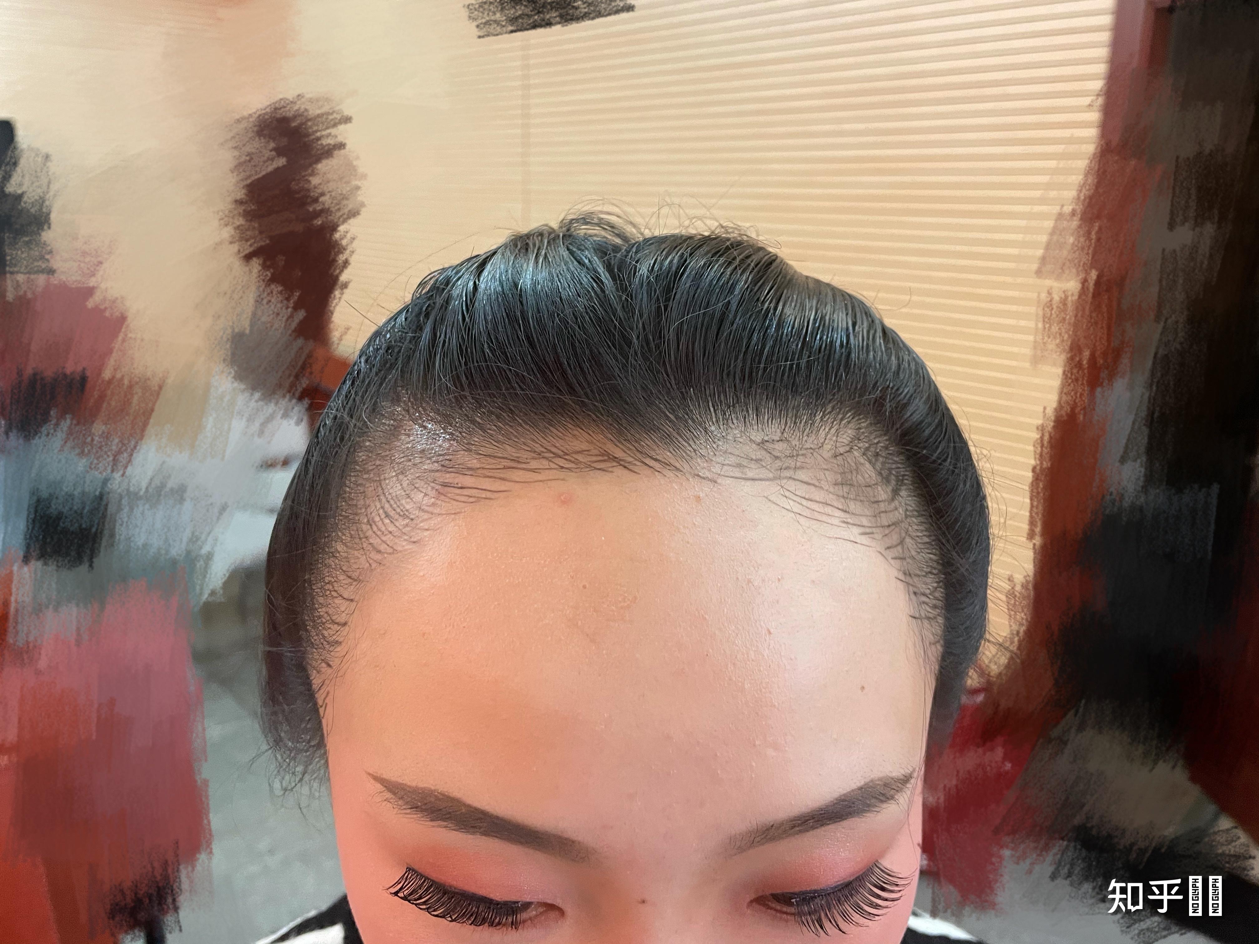 遗传的m字发际线,19岁这个发际线算高吗? - 知乎