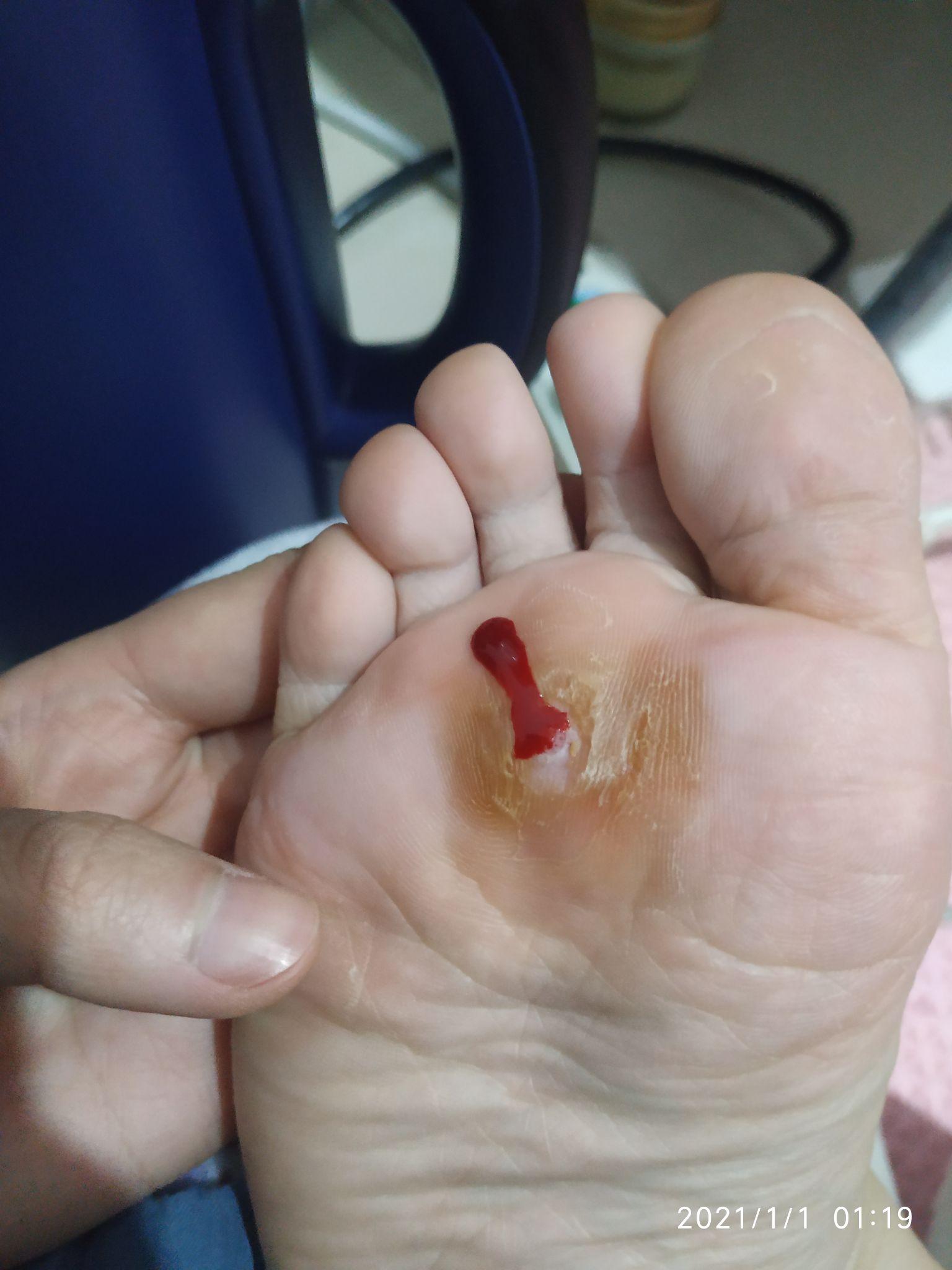 鸡眼怎么彻底挖出? - 知乎