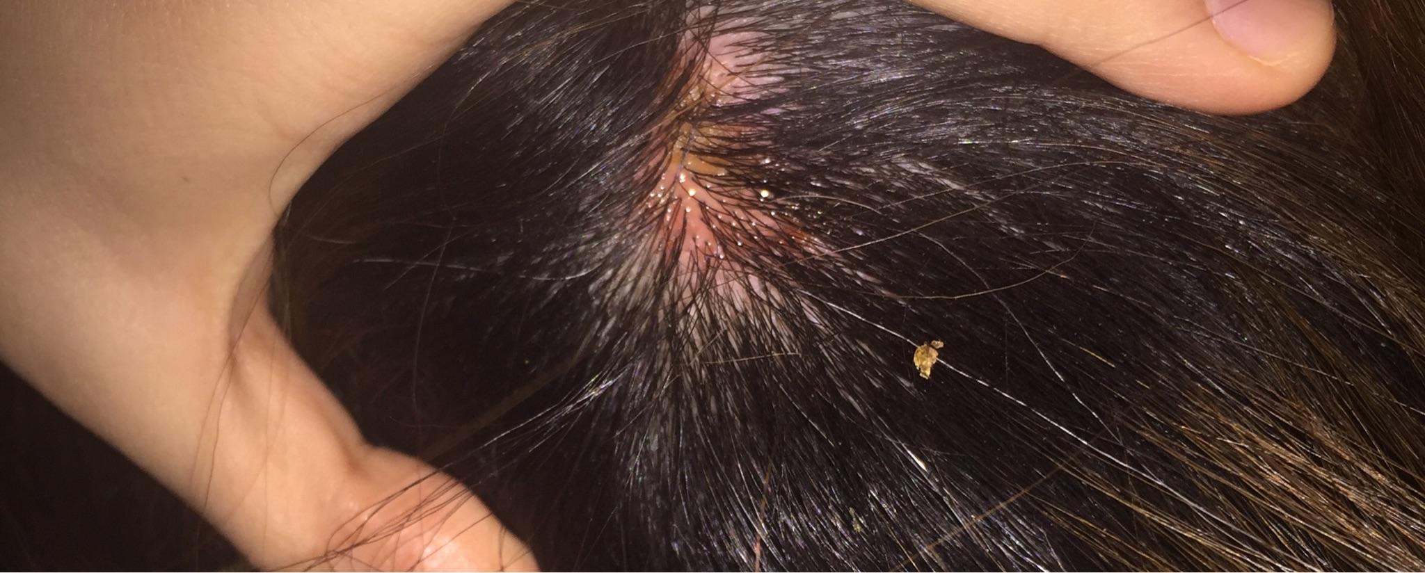 一直挠头头上有许多结痂怎么能不挠这是怎么回事而且挠完扣下结痂会有