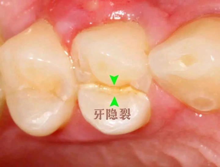 牙齿外伤种类多,你知道哪一个? - 知乎