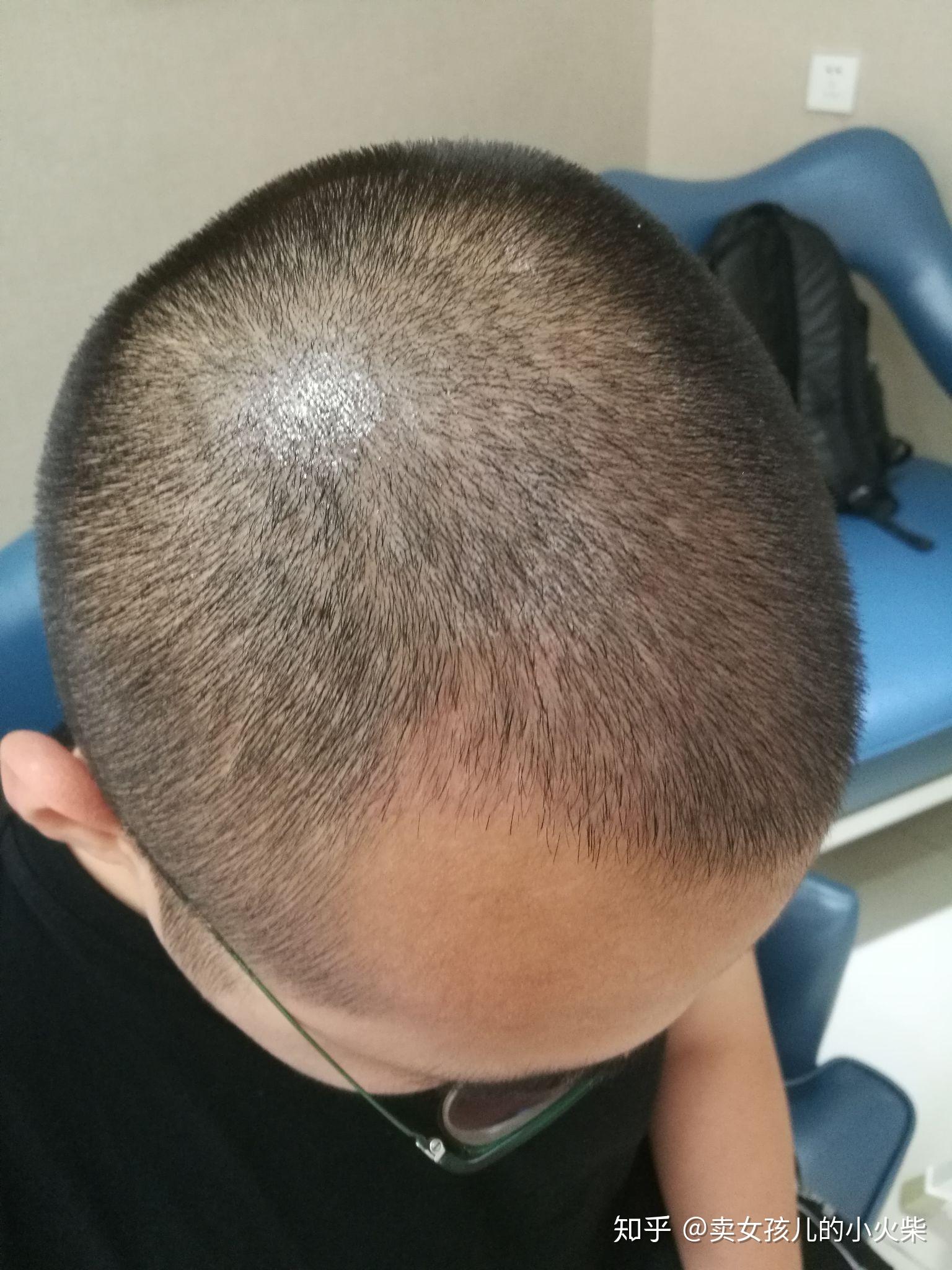 男性头顶脱发和发际线上移,需要植发吗? - 知乎