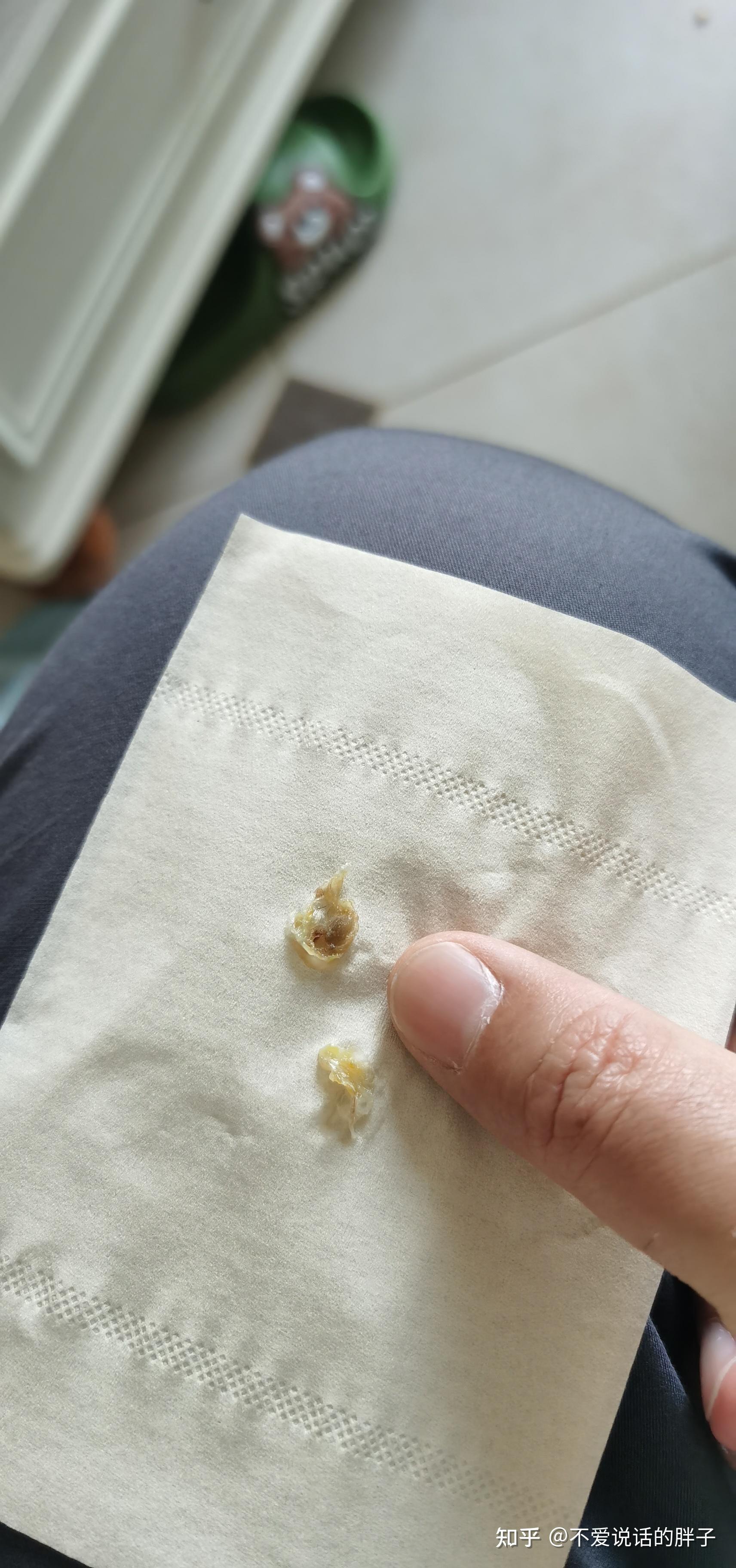 人的鼻屎能大到什么程度? - 知乎