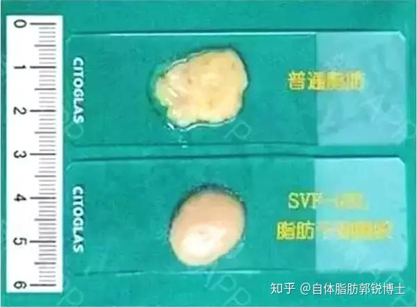 自体脂肪SVF填充，比自体脂肪更牛？ - 知乎