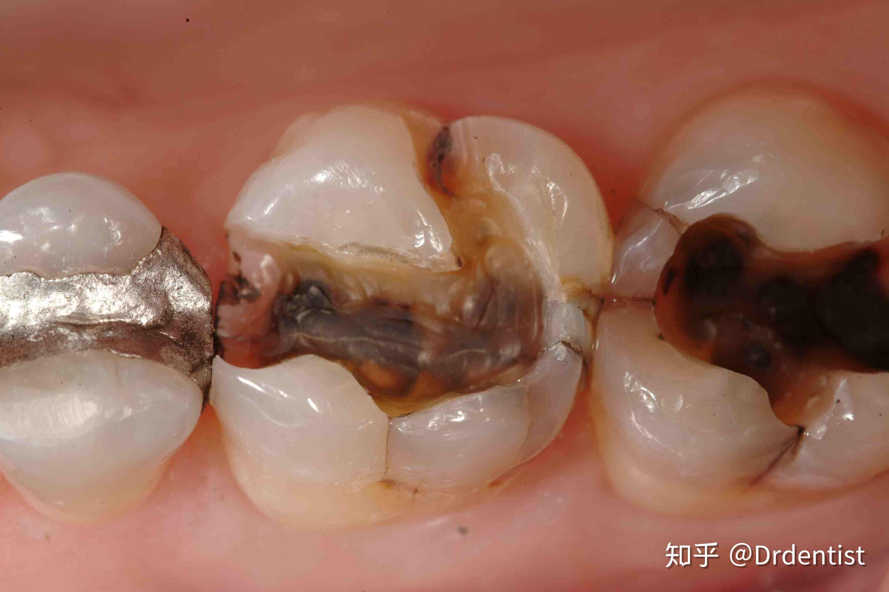 牙医怎么发现患者牙隐裂的