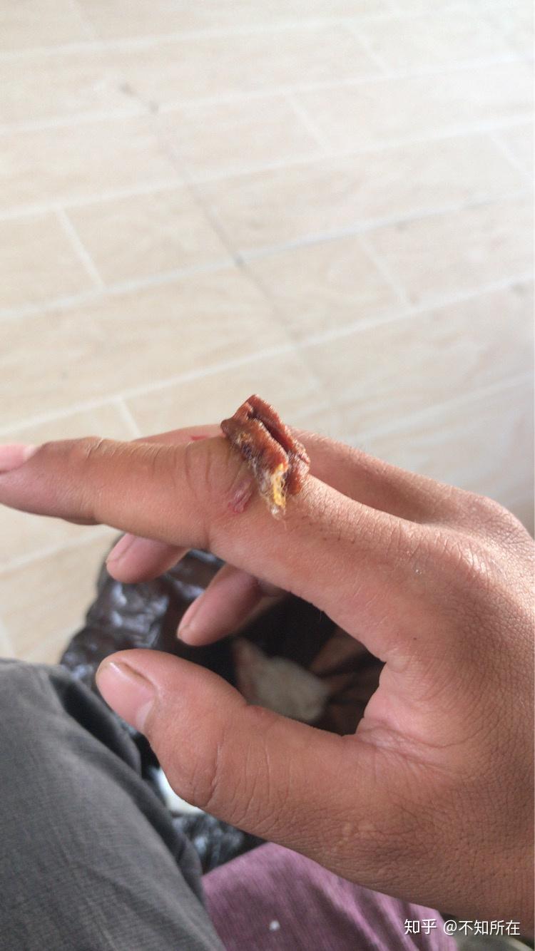 被老鼠咬了怎么办?