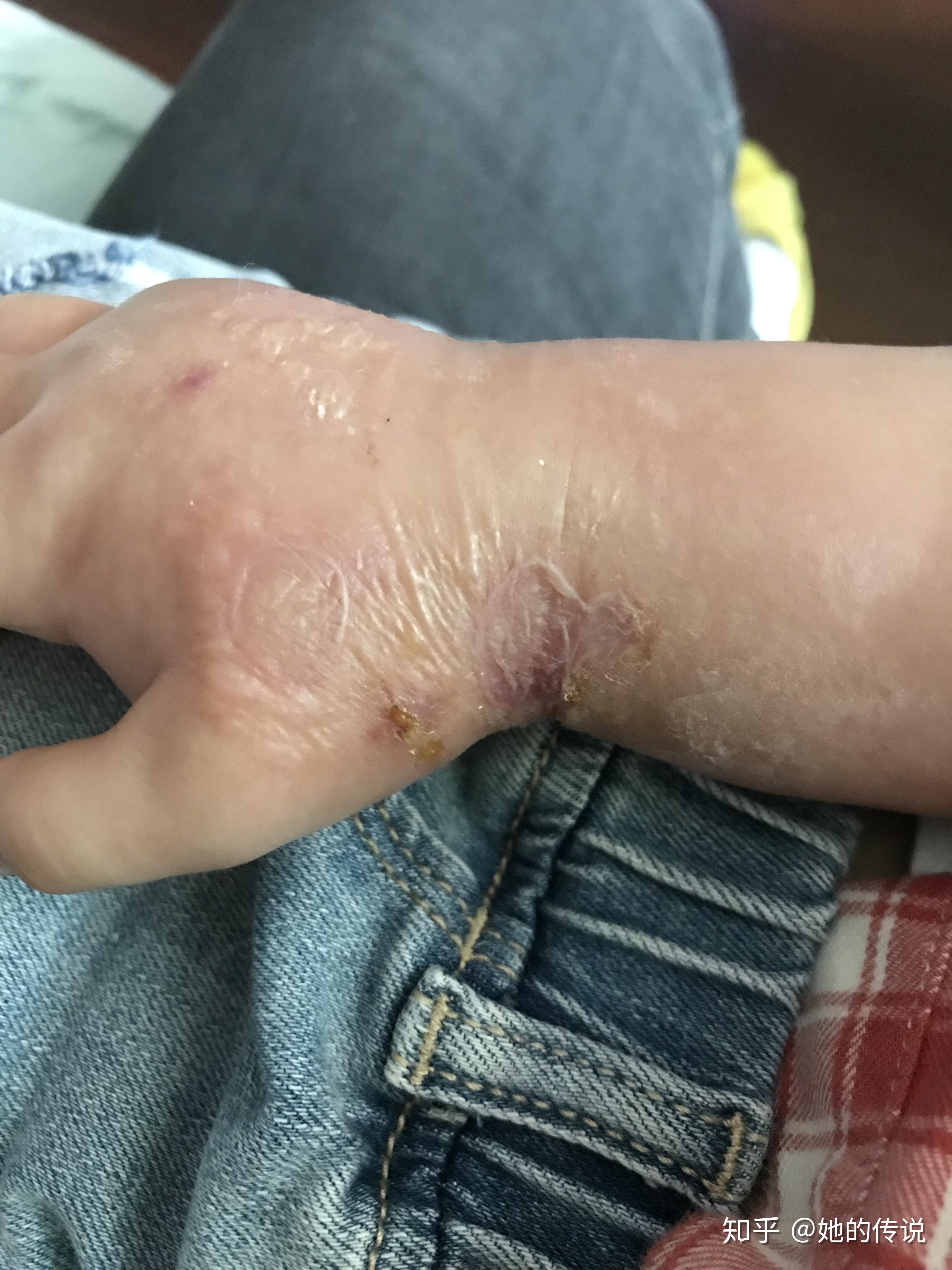 被隐翅虫咬了怎么治让他自己好还是要看医生