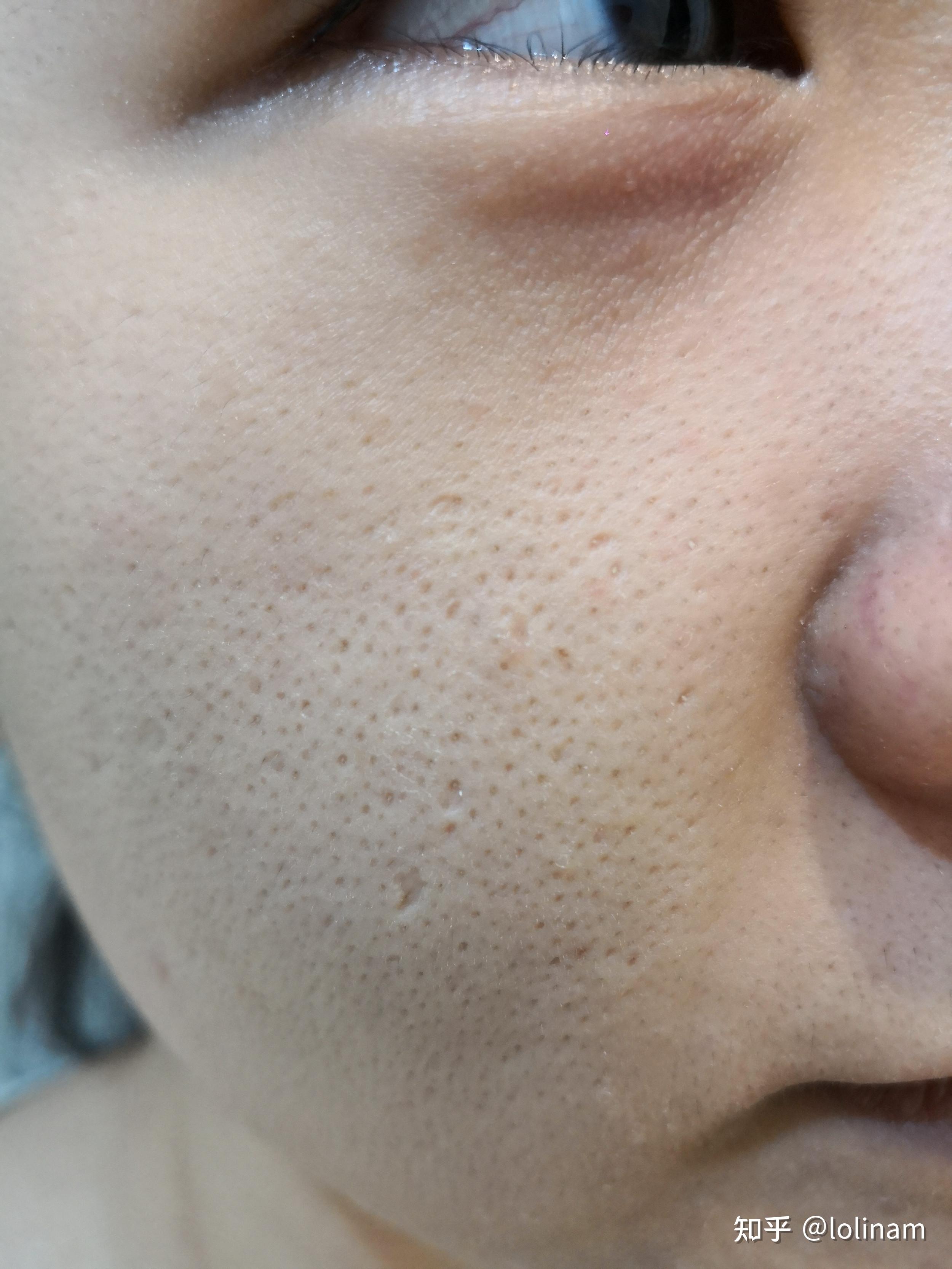 毛孔粗大用洗面奶有用吗