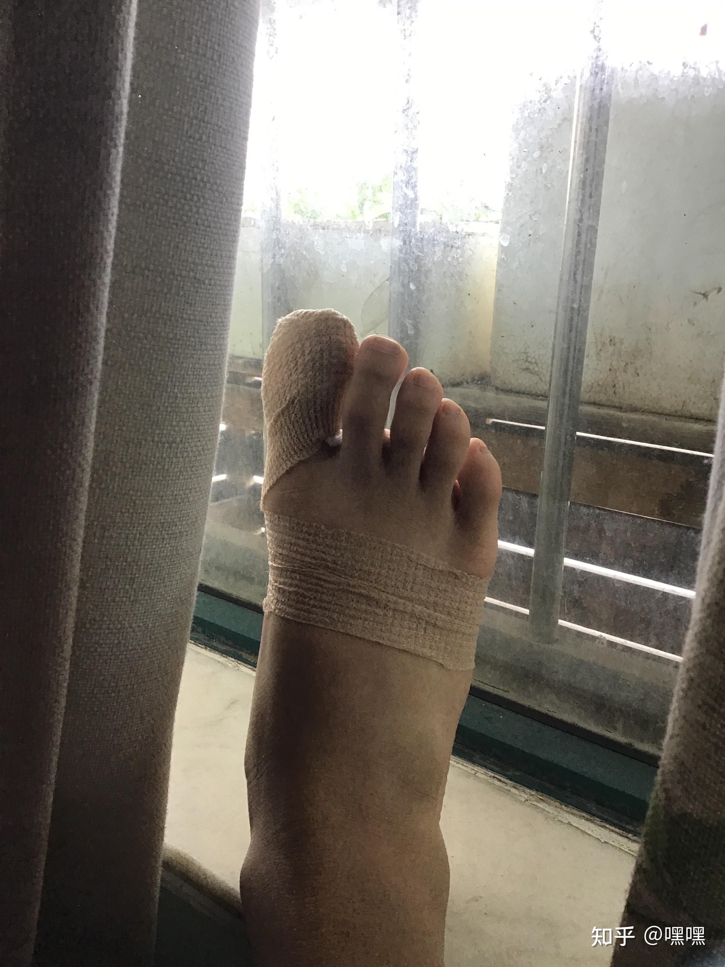 大脚趾甲盖整个掀起来了怎么办?