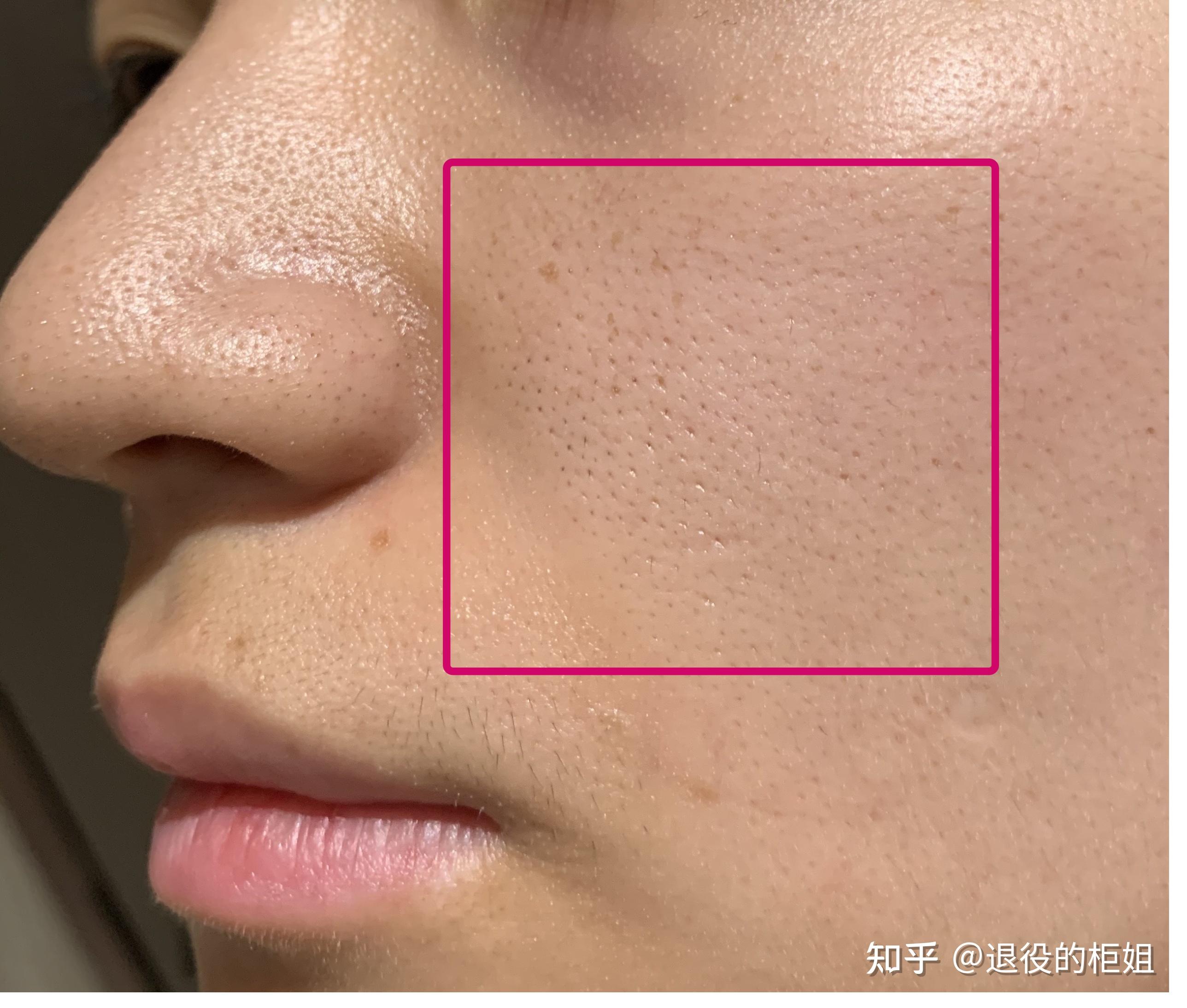 现在不知道我是脸是什么问题了 感觉又像脂质微丝又像黑头白头又是