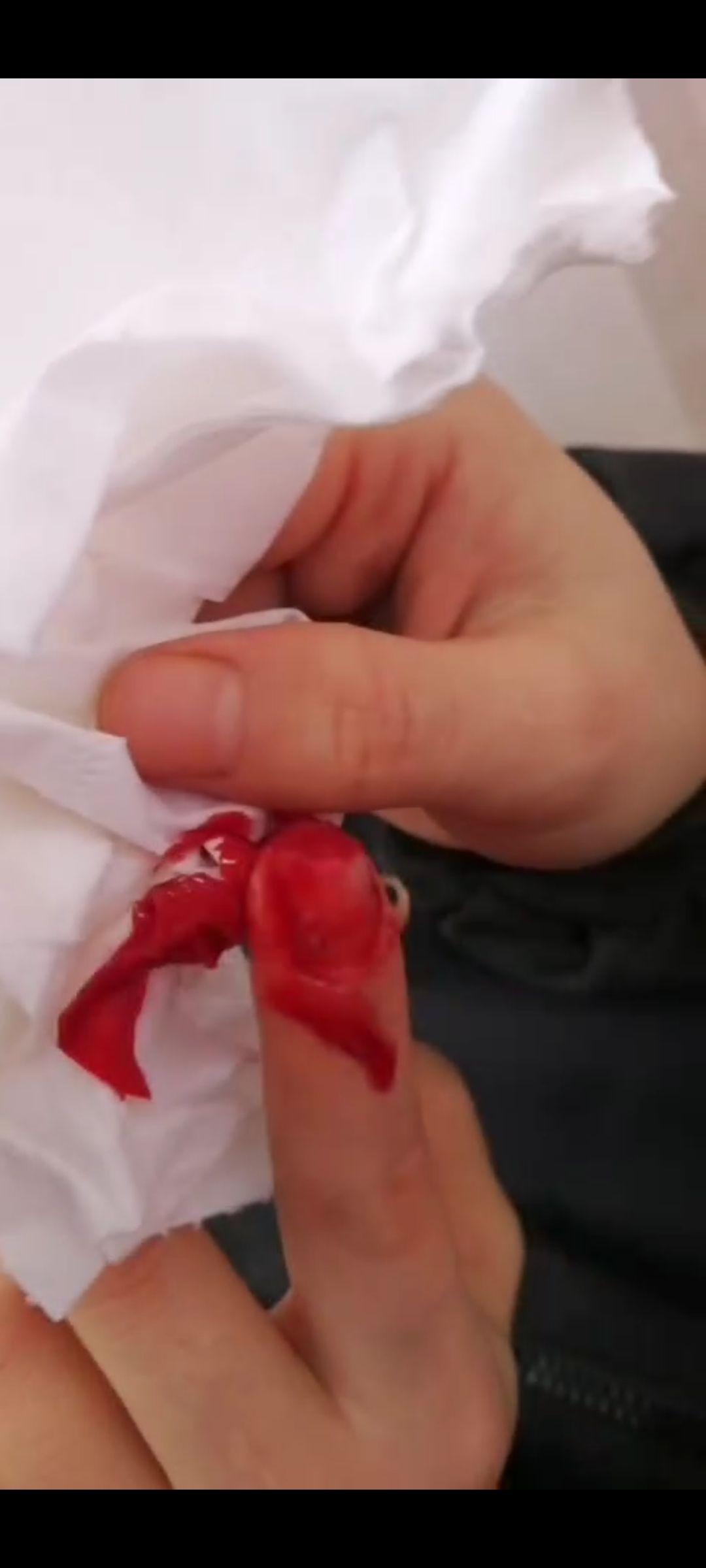 手指切断了还能康复吗? - 知乎