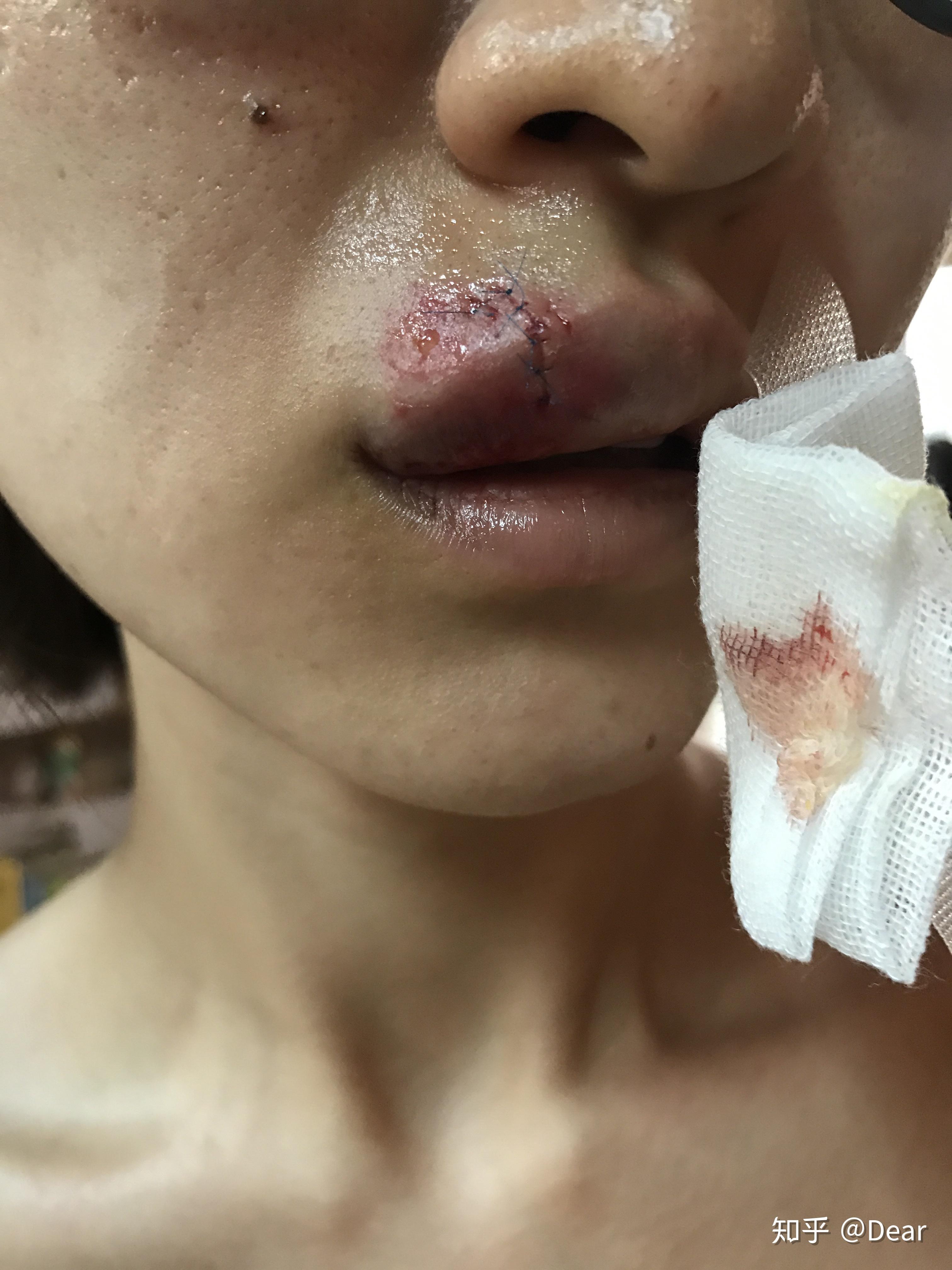 缝针和拆线可怕吗疼吗你们当时怕吗