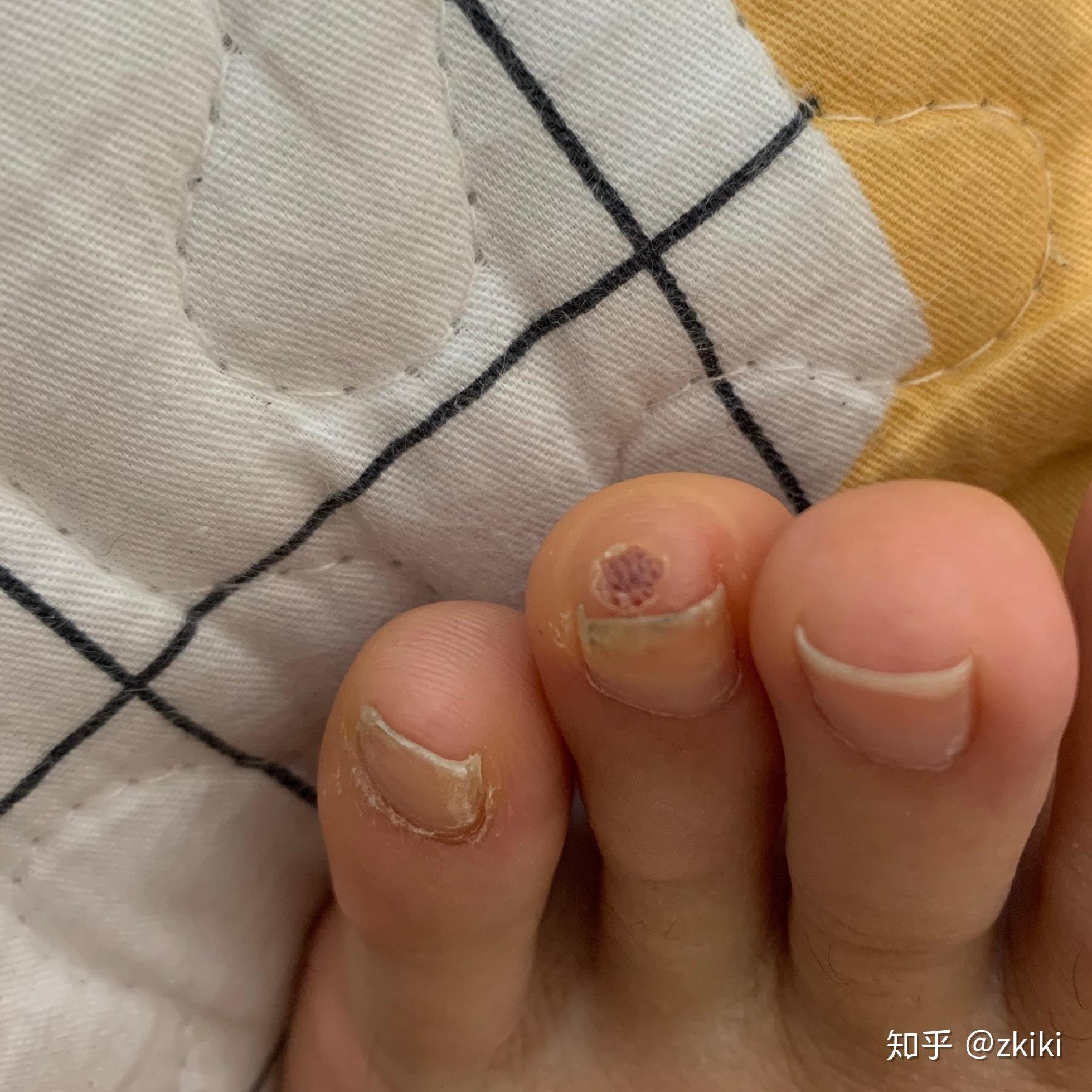 甲下寻常疣做液氮冷冻疼哭了,可耐受疼痛真的这么厉害吗?